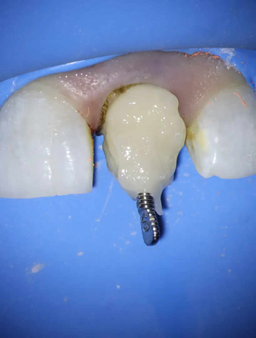 Fiber post placement for intraradicular reinforcement